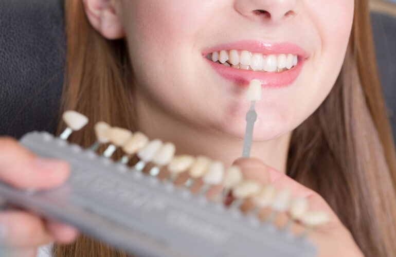 Dental Veneers