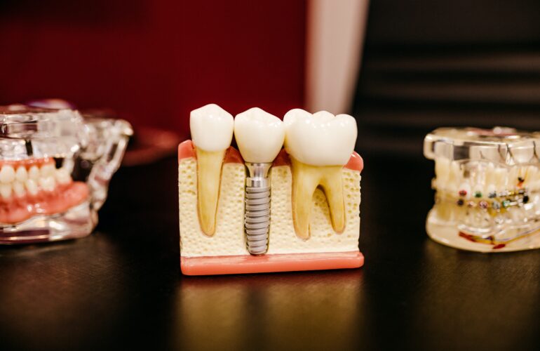 cross section of a dental implant