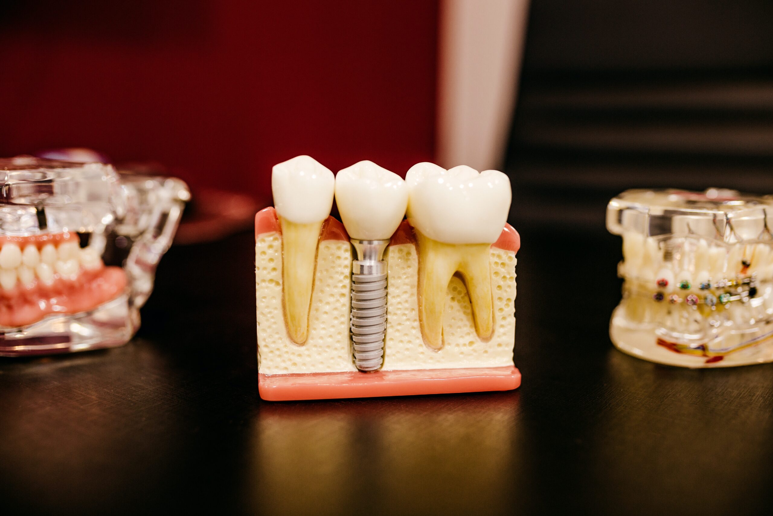 cross section of a dental implant