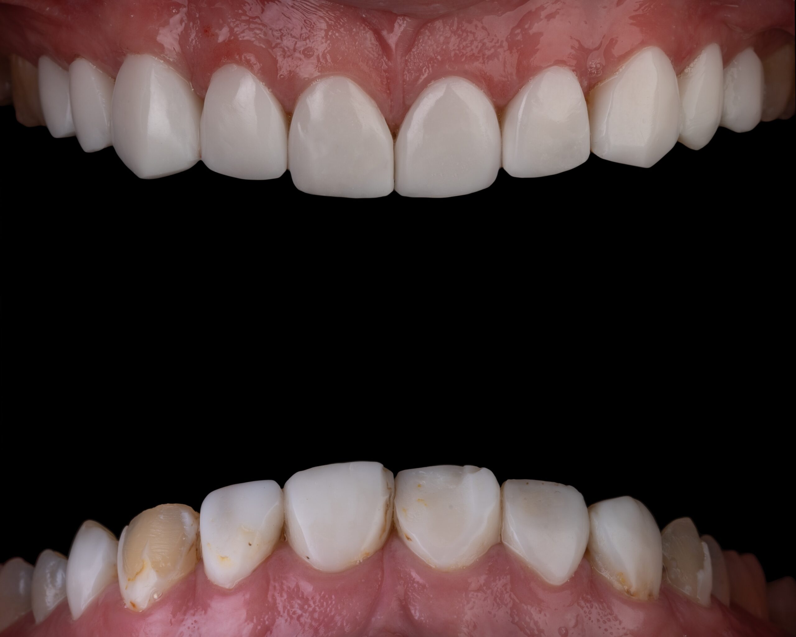 discolored teeth