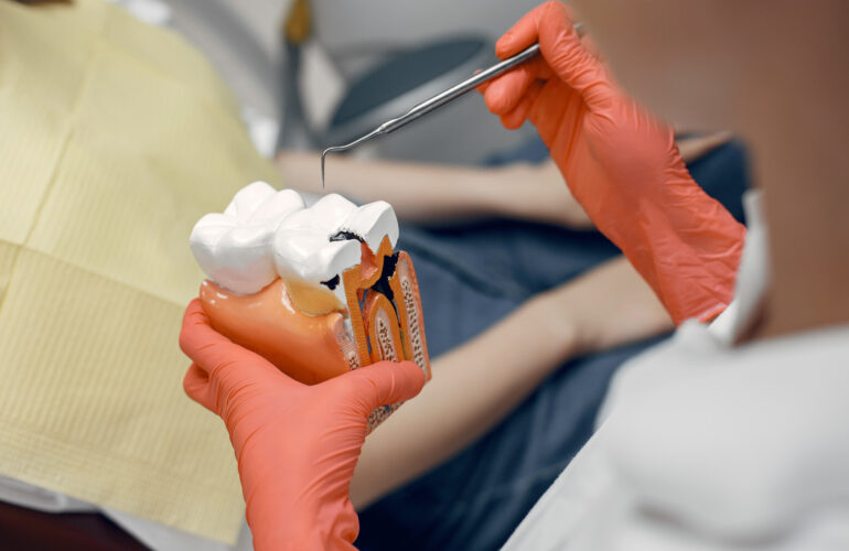 Root canal process