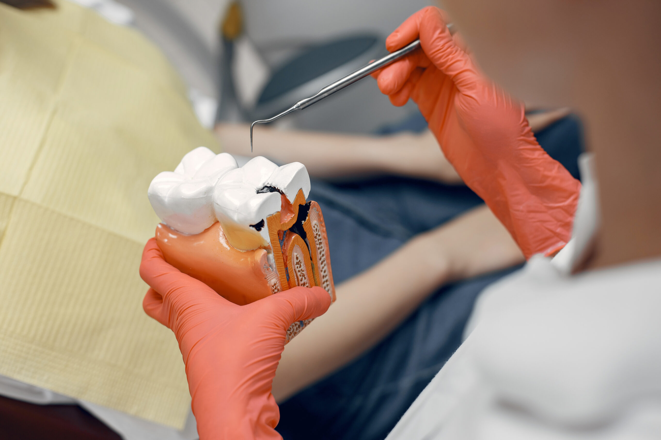 Root canal process