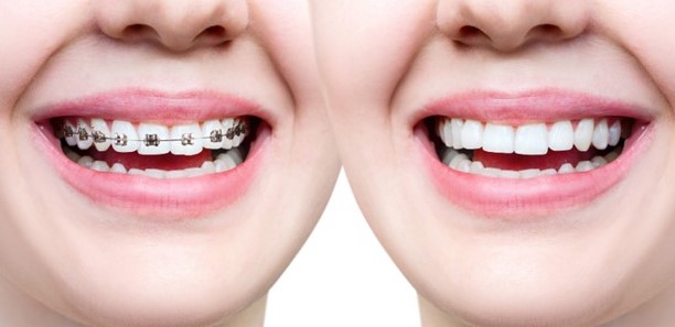 Aligners vs Braces