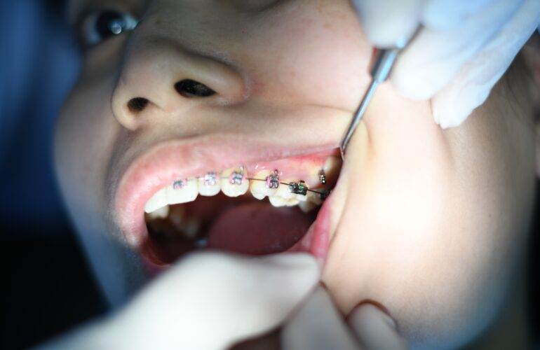 A girl getting braces fixed