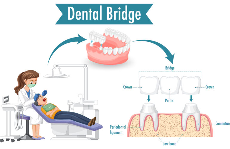 dental bridges