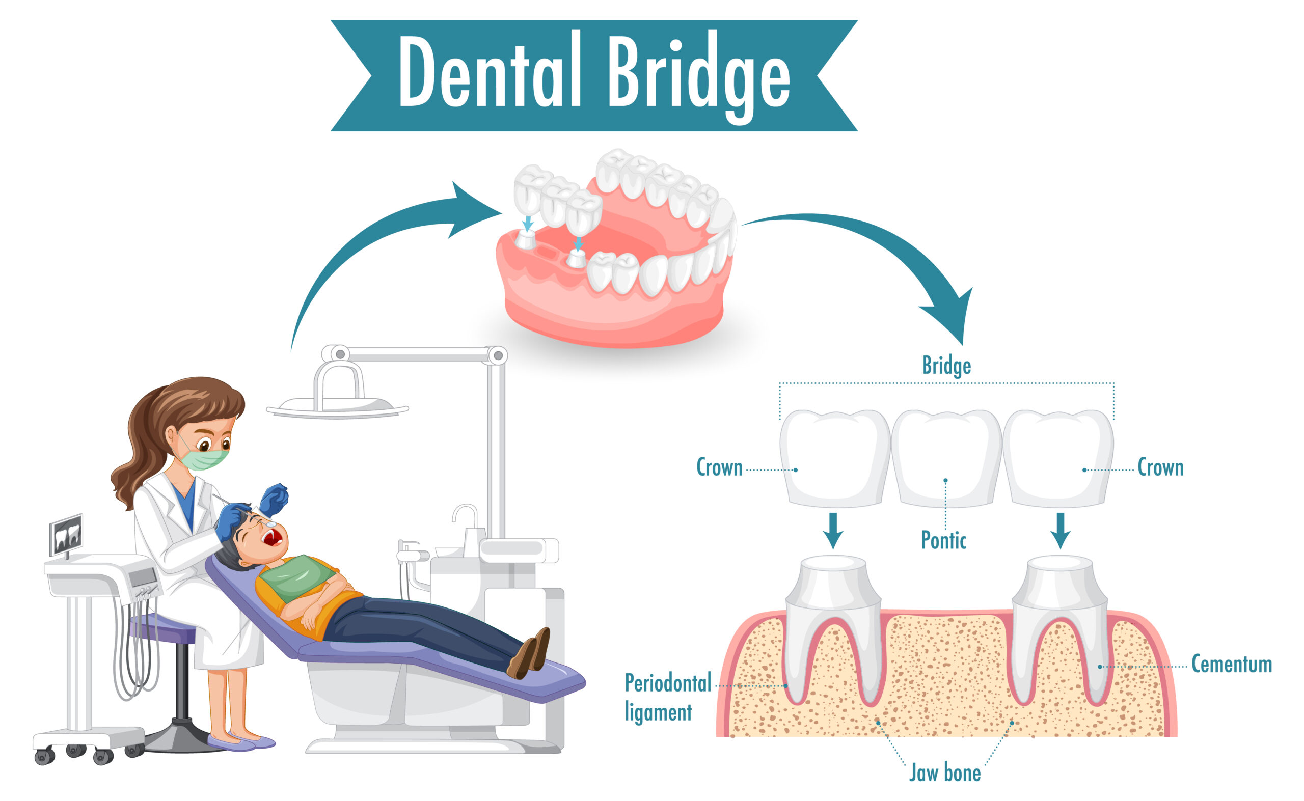 dental bridges