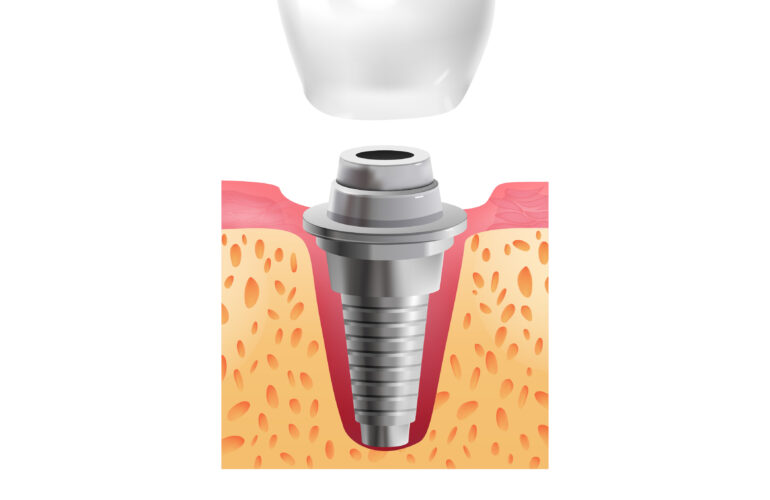 dental implant