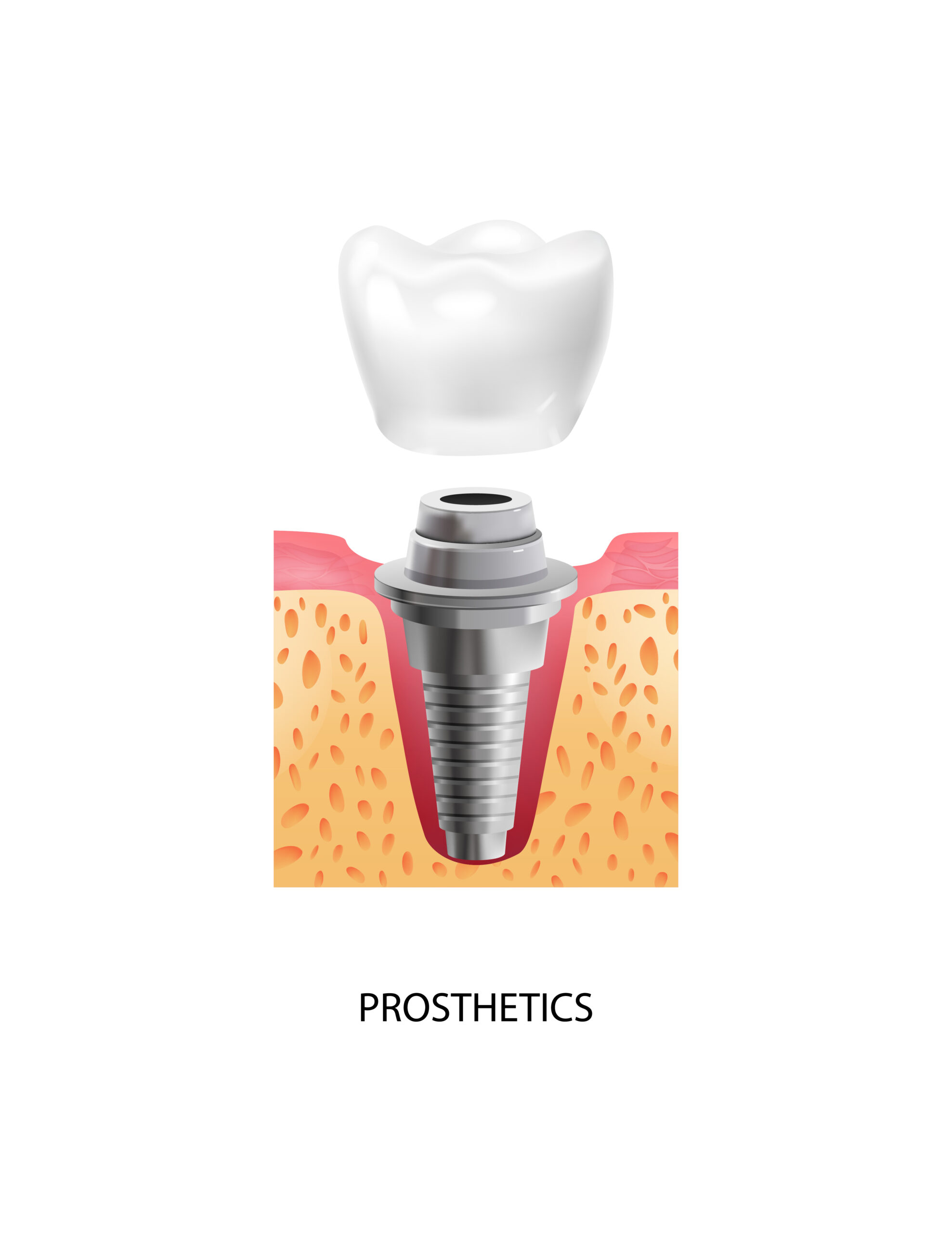 dental implant